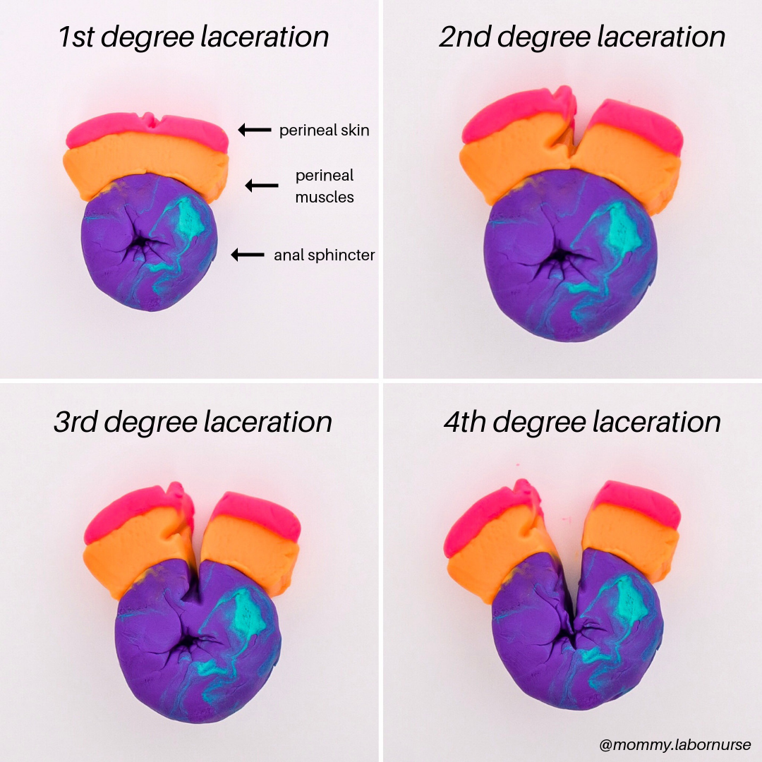 How To Prevent Tearing During Birth: As Told By A Labor Nurse