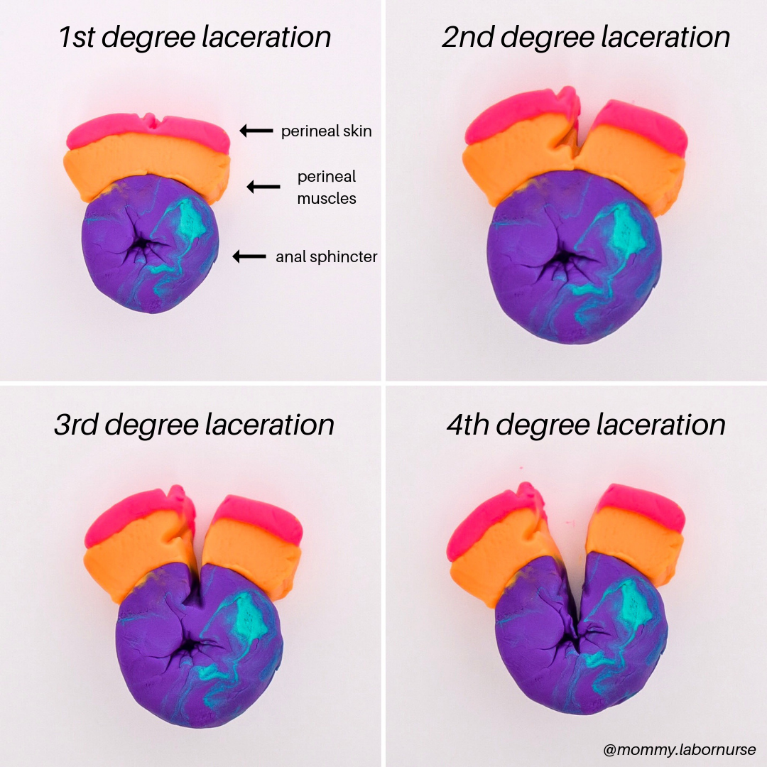 birth tear degrees infographic