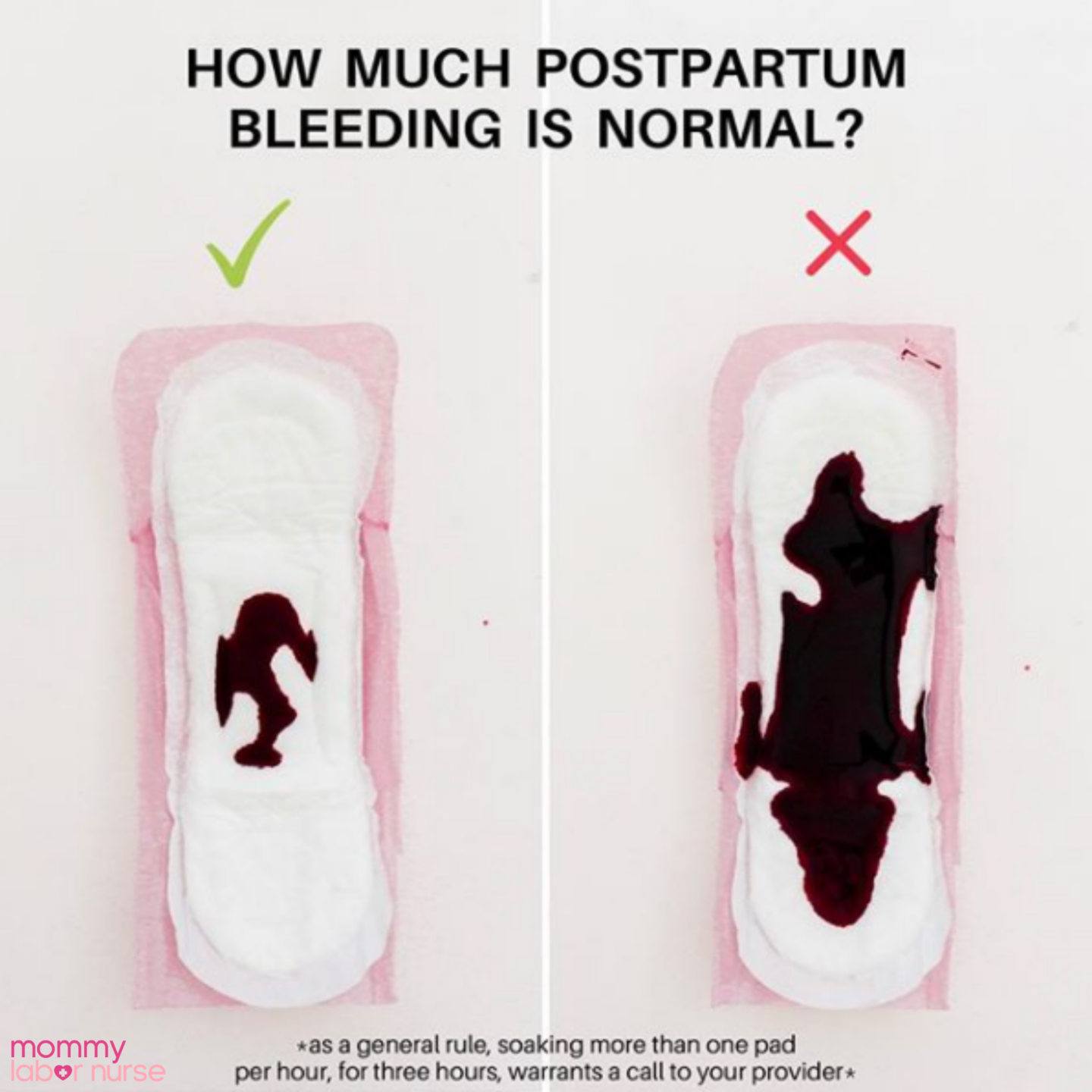 postpartum bleeding infographic