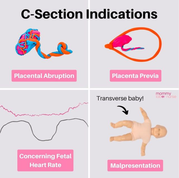 c section indications infographic