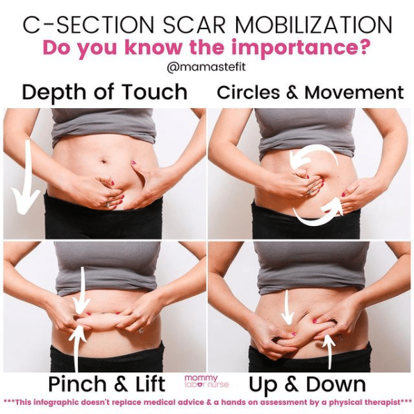 12 C-Section Recovery Tips To Heal Fast  C section recovery, C section,  Pregnancy tips